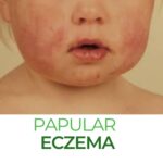 papular eczema in children