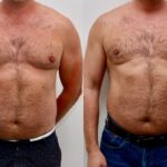 gynecomastia surgery clinic in uae