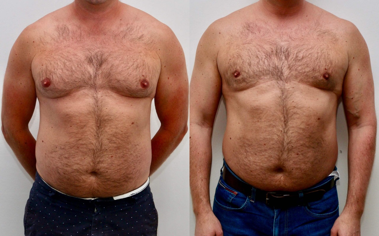 gynecomastia surgery clinic in uae